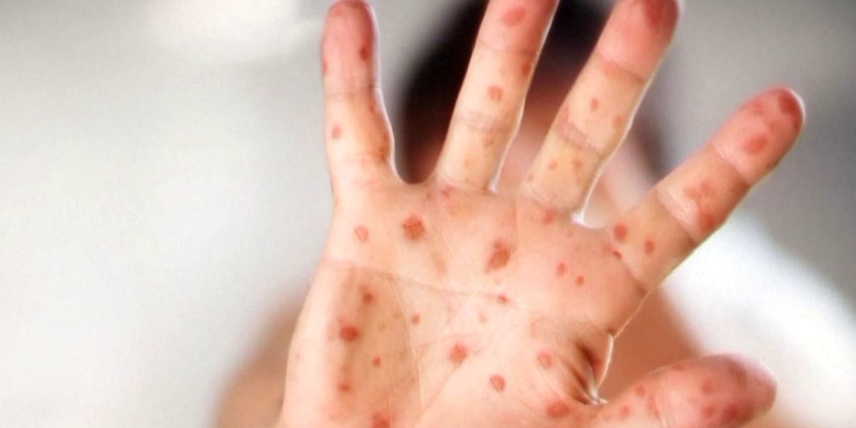 Breaking: Missouri Health Officials Confirm New Measles Case in Adult Resident
