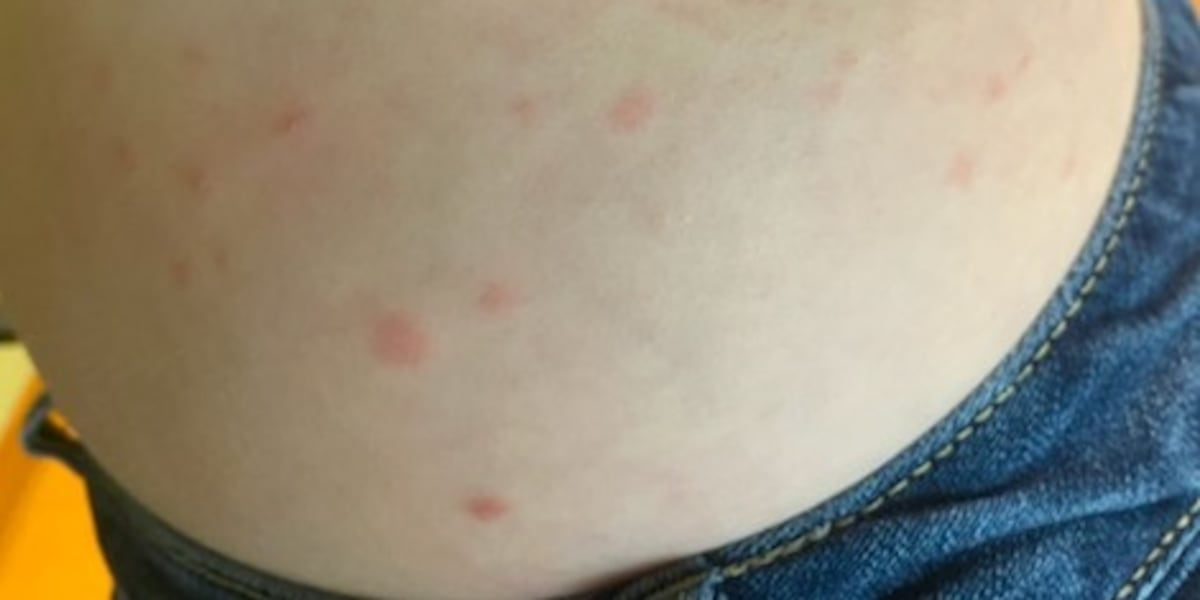 Freshwater Rash On Your Side: Swim in lakes, creeks and rivers? Know about swimmer’s itch